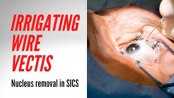 Nucleus removal in Small incision Cataract Surgery : Irrigating  Wire Vectis