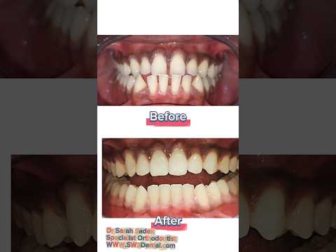 Before and after: 8 months of clear aligners: before and after