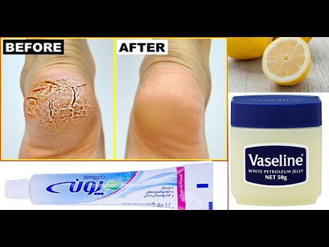 تصویری: 3 روش برای درمان خشکی دست های ترک خورده