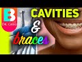 Most Common Cavities With Braces &amp; How to Prevent Them
