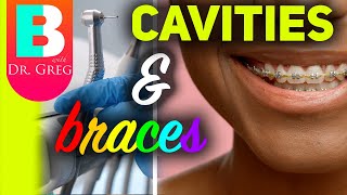 Most Common Cavities With Braces & How to Prevent Them