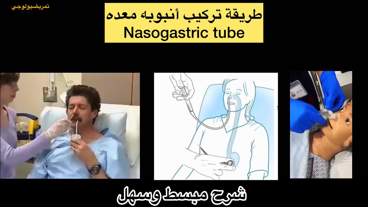 طريقه تركيب انبوبه معده (Nasogastric tube )
