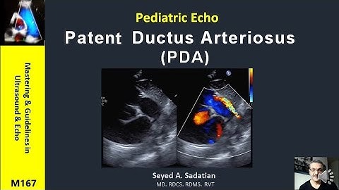 Pediatric Echo : Patent Ductus Arteriosus (PDA)