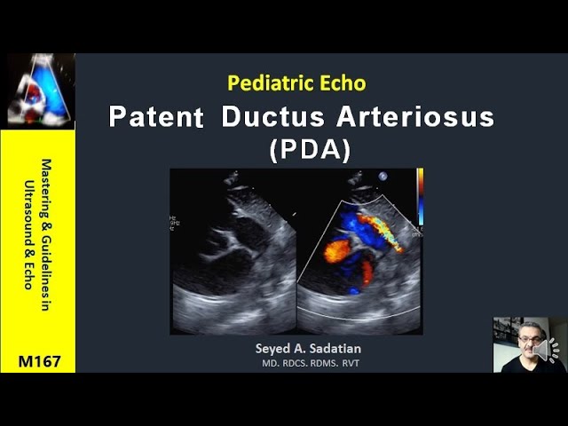 Pediatric Echo : Patent Ductus Arteriosus (PDA) class=