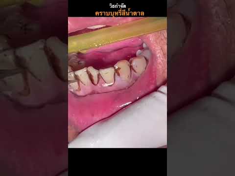 วีดีโอ: 3 วิธีในการขจัดคราบสีน้ำตาลออกจากฟัน