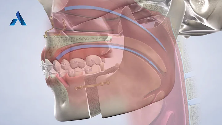 Sleep Apnea at Alfi Oral, Dental Implant & Facial ...