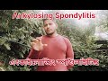 ANKYLOSING spondylitis #video #subcribi #viralvideo #fitness #traditinal#viralshort #motivation#Gym 