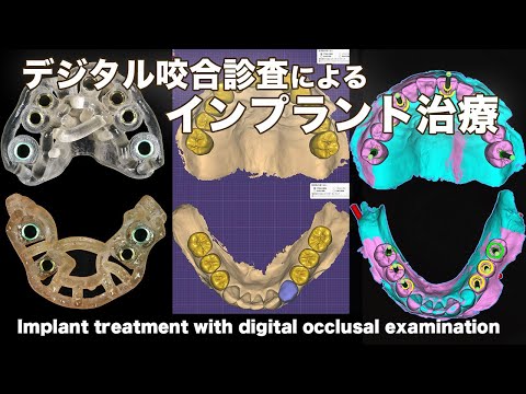 デジタル咬合診査による【インプラント】の流れ Implant with