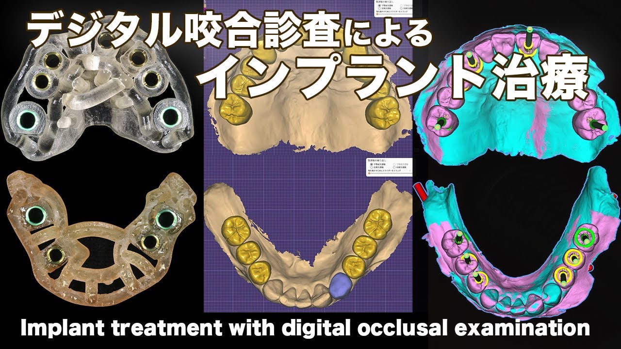 デジタル咬合診査による【インプラント】の流れ Implant with digital