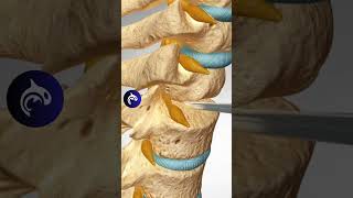 How does Spinal Fusion Surgery Work? ACDF 3D Animation #medicalanimation