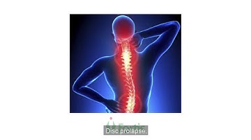 Dr. Rahul Gupta | Fortis, Noida | Neurosurgery