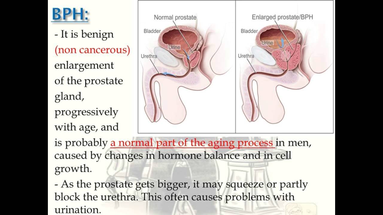 geriatrics - Benign prostatic hyperplasia (BPH)