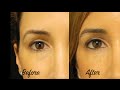 No More Tired Eyes - Under Eye Filler and Botox with Tanya Patron, PA-C - Miami Plastic Surgery