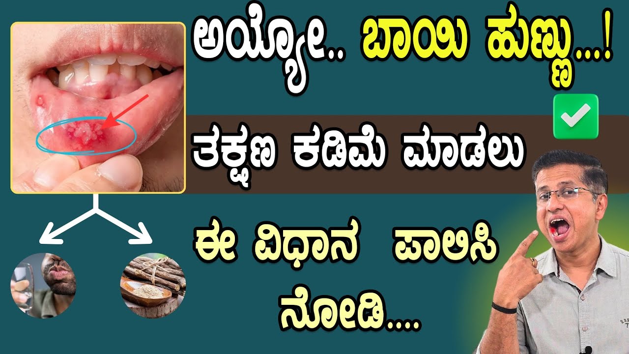 ಬಾಯಿ ಹುಣ್ಣು...! ತಕ್ಷಣ ಕಡಿಮೆ ಮಾಡಲು ಈ ವಿಧಾನ  ಪಾಲಿಸಿ ನೋಡಿ | Best Remedies For Mouth Ulcer