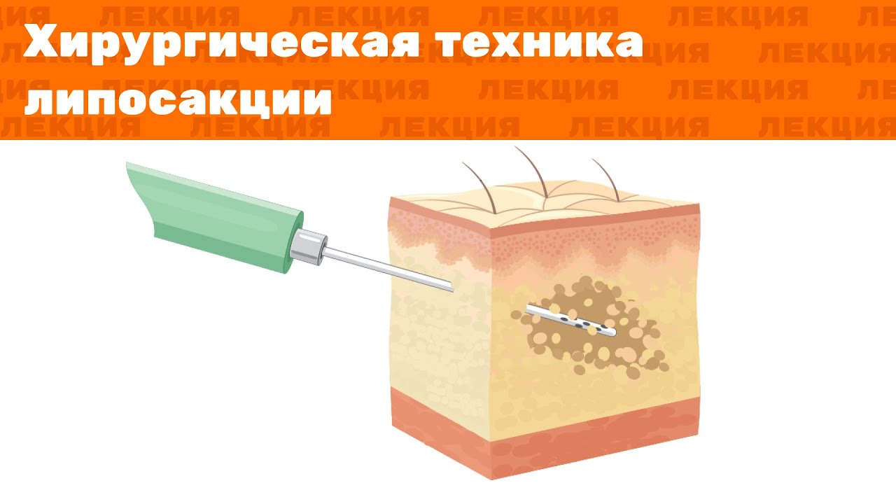 Лекция: Липосакция — хирургическая техника - YouTube