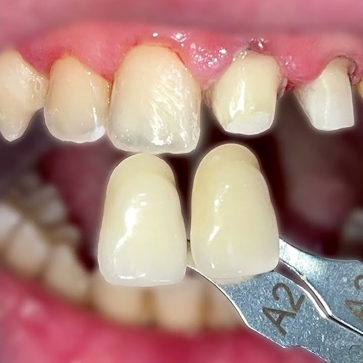 Natural Looking Crowns   |  Dental Crowns