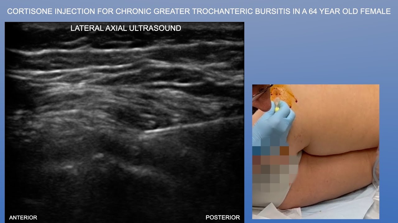 Ultrasound of a Greater Trochanteric Bursitis Injection in a 64 Year ...