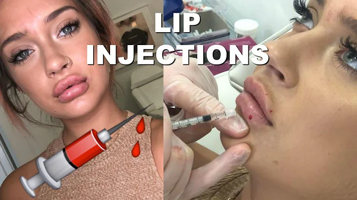 THE TRUTH ABOUT LIP INJECTIONS | SARA VIDAL