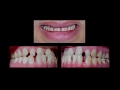 Invisalign and Dental Veneers to One Patient at Cosmetic Dental Associates