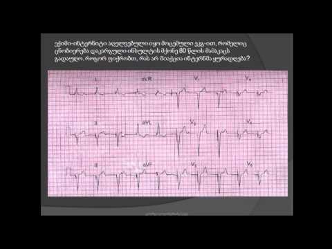 ეკგ. მუდმივი კარდიოსტიმულატორი სრული ატრიოვენტრიკული ბლოკადის გამო / სპაიკები / ათეროსკლეროზი