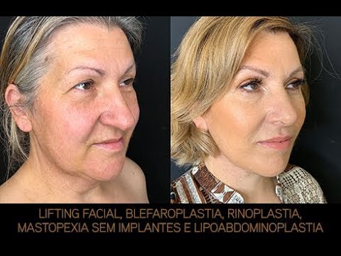 Vídeo: Blogueira Ucraniana Com Bochechas Anormalmente Redondas Mostrou Uma Foto Antes De Uma Cirurgia Plástica Facial