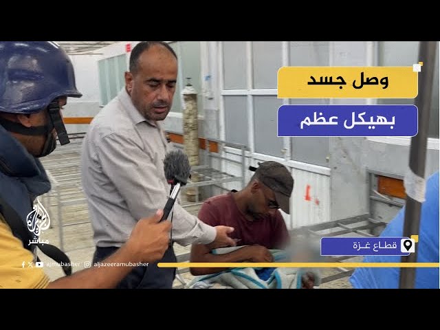 الدكتور محمد أبو سلمية: هذا الطفل وصلنا الآن بسوء تغذية لم نره من سنوات ..