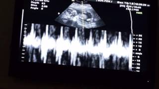 Baby Gender Reveal: 17 Week Pregnancy 2D 3D 4D Ultrasound Sonogram At Prenatal Peek It's A BOY! VLOG Baby Gender Reveal: 17 Week Pregnancy 2D 3D 4D Ultrasound Sonogram At Prenatal Peek It's A BOY! VLOG