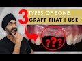 3 Types of Dental Bone Grafts That I Use Routinely