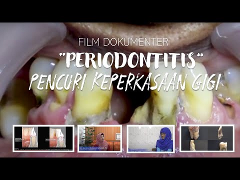 Video: Periodontitis - Pengobatan Periodontitis Dengan Pengobatan Tradisional Dan Metode