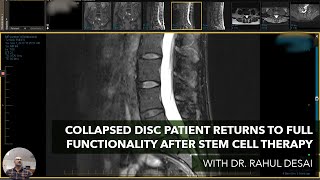 Collapsed Disc Patient Returns to Full Functionality after Orthobiologic Cell Therapy