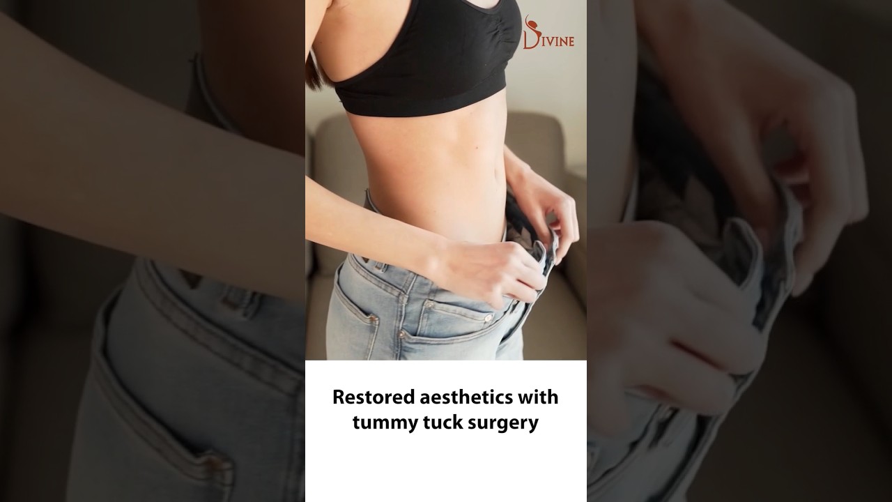 Before and After Tummy Tuck Results by Dr. Amit Gupta 