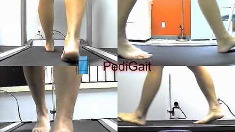 Flatfoot 4 camera gait analysis.avi