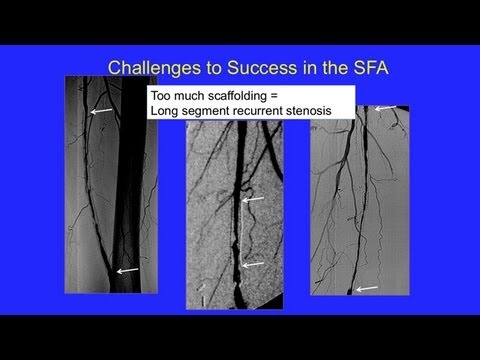 UCSF Vascular Surgery