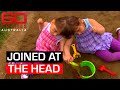 The conjoined twins who see, smell and think the same things | 60 Minutes Australia