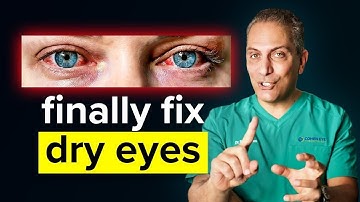 The Ultimate Dry Eye Treatment Guide (From Mild to Severe Cases)