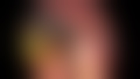 Endoscopic-Guided Transgastric Laparoscopic Retrieval of a Duodenal Stent