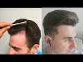 Hairline before a hair transplant