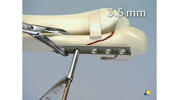 Malleolus - Type B Malleolar Fracture 44B - Plate Fixation