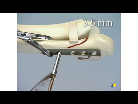 Malleolus - Type B Malleolar Fracture 44B - Plate Fixation