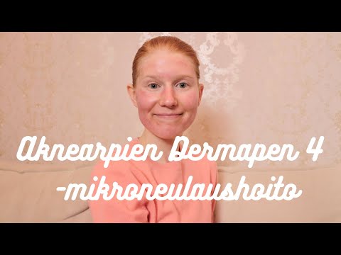 Aknearpien Dermapen4  -mikroneulaushoito ~ Nina Jasmin