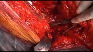 Ver vídeo: Cirugía de rescate acetabular con defectos óseos graves