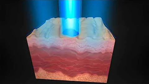 How does Picosure laser skin rejuvenation at S-Thetics Clinic work?