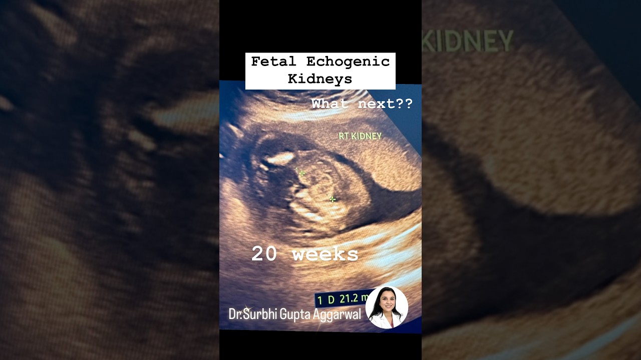 Fetal echogenic kidneys | Dr.  Surbhi Gupta Aggarwal | Consultant Radiologist.