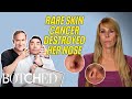 Cancer Took A Bite Out of Shelley’s Nose And Left A MASSIVE Hole?! (Before & After) | Botched | E!