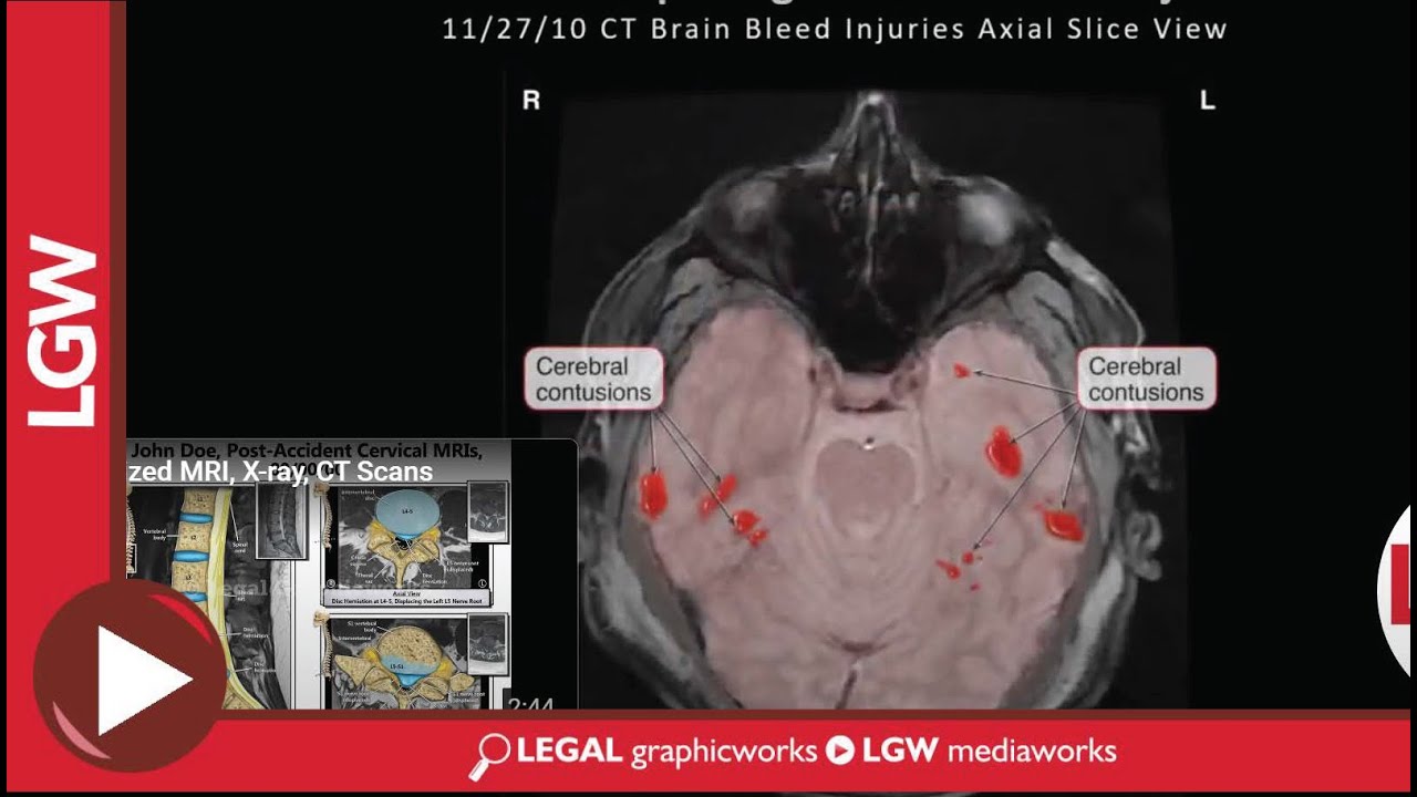 Colorized Mri Segment Animated Colorized MRI and CT Scans - YouTube