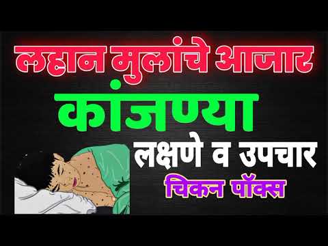 कांजण्या लक्षणे व उपचार, कांजण्याची लक्षणे, चिकन पॉक्स उपाय, कांजण्या काय काळजी घ्यावी