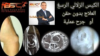 ألم وتورم الرسغ الكيس الزلالي في معصم اليد علاج النهائي