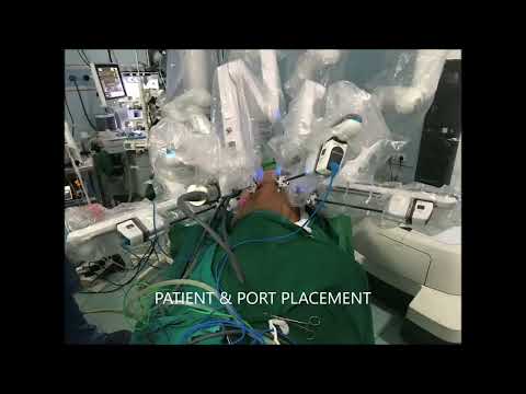 robotic left lower lobectomy with Mediastinal LN dissection