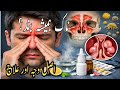 Chronic Stuffy Nose Causes &amp; Treatment | Constant Blocked Nose Solution #BlockedNose