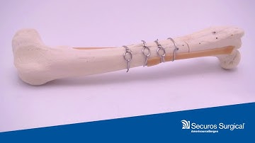 Securos University Tips & Tricks: DIY Loop Cerclage